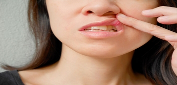 אפטות בחלל הפה – הטיפול הנטורופתי